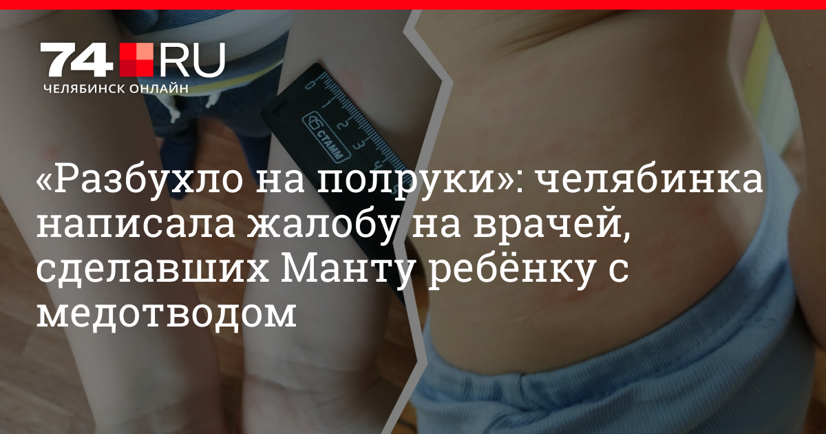 Эксперт: проба Манту часто дает ложноположительные результаты из-за аллергической реакции