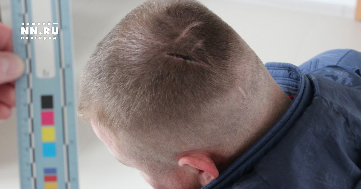 шрам на затылке. камуфлирование рубцов перманент. шрам на затылке. шрам на затылке. шрам на затылке.