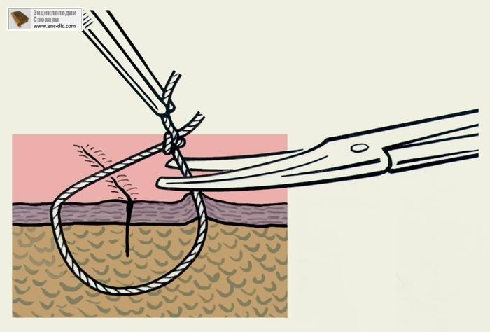 Как снять швы в домашних условиях ? Простой узловой кожный шов - YouTube