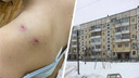 «Раны глубокие и рваные»: в Северодвинске собака сильно покусала школьницу — что об этом известно