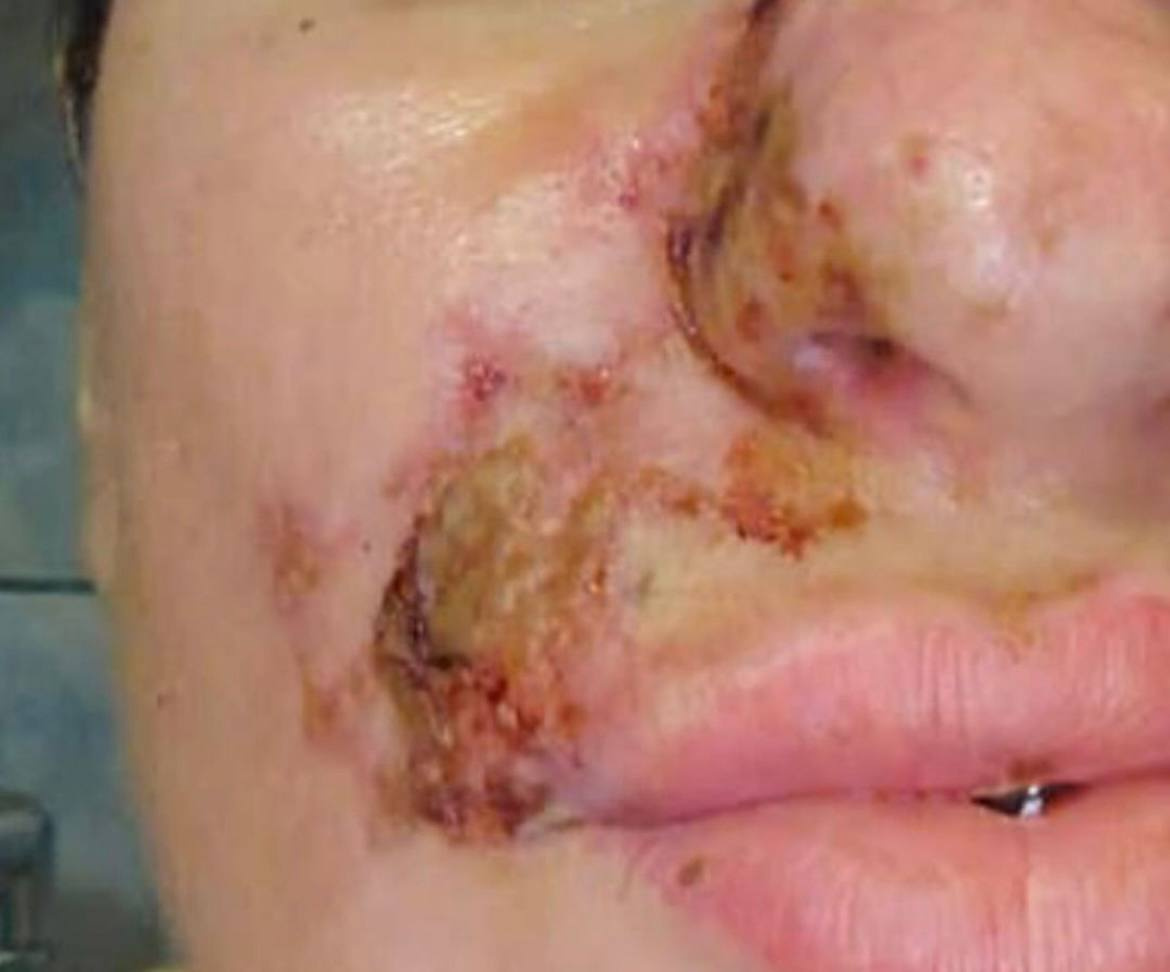 Женщина в Чите пострадала от рук неквалифицированного косметолога