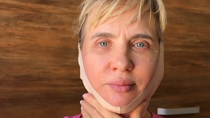 Много швов и адская боль. Сургутянка из «Дома-2» показала, как выглядит ее мать, перекроившая лицо