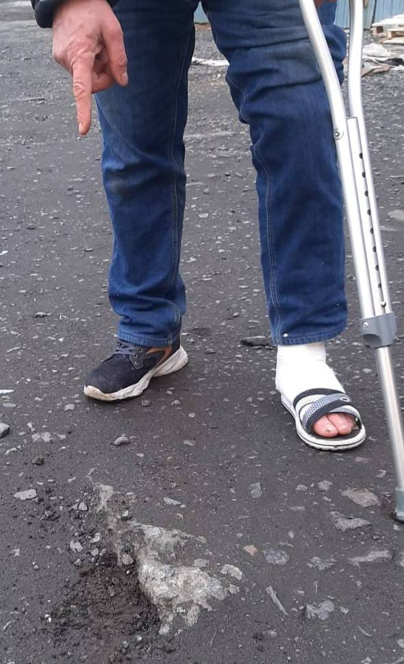 человек с переломанными ногами. работник сломал ногу. гипсовая повязка на стопу. травмированный человек. работник сломал ногу.