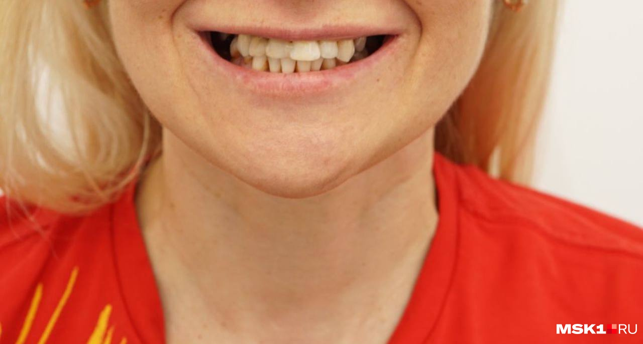 Так выглядели зубы Елены до лечения в клинике