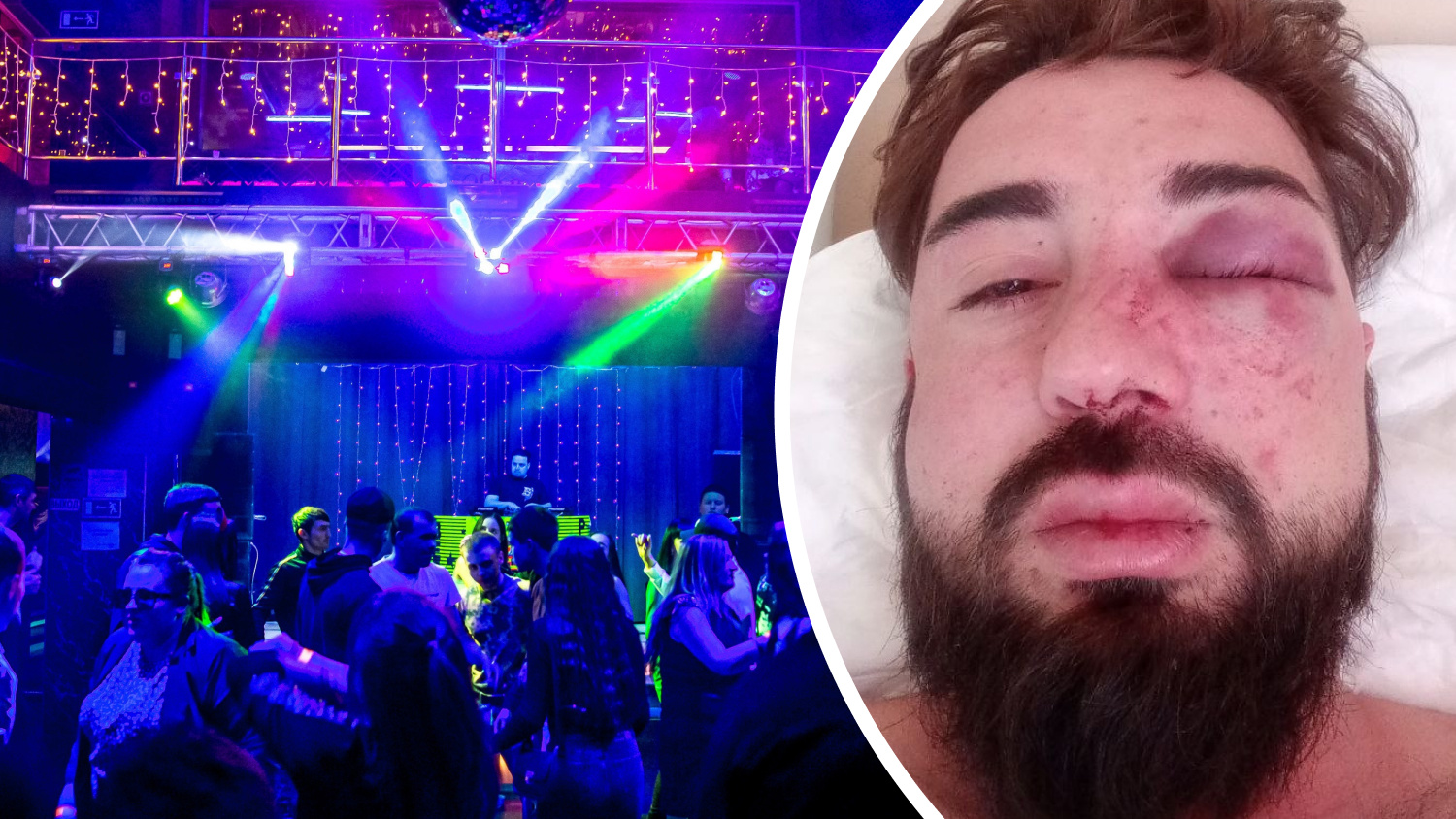 «Напали толпой как дворняги!»: балаковца избили в ночном клубе из-за поддержки СВО