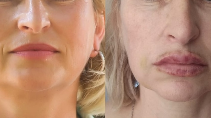 Слева — фотографии Ирины до процедур у лжекосметолога, справа — после