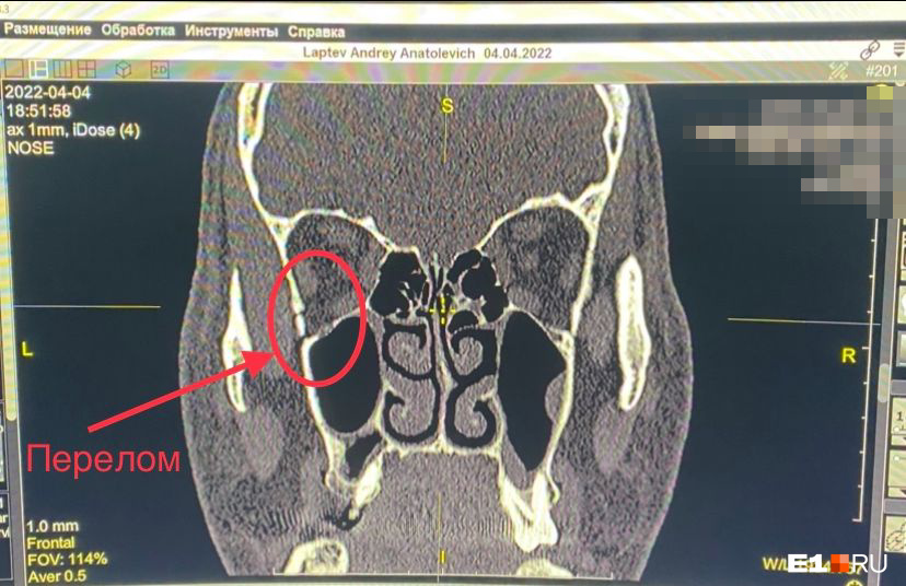 Перелом стенки левой орбиты