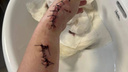 «Шрамы ужасные». Избитая студентом МГУ во Владивостоке девушка готовится к пластическим операциям