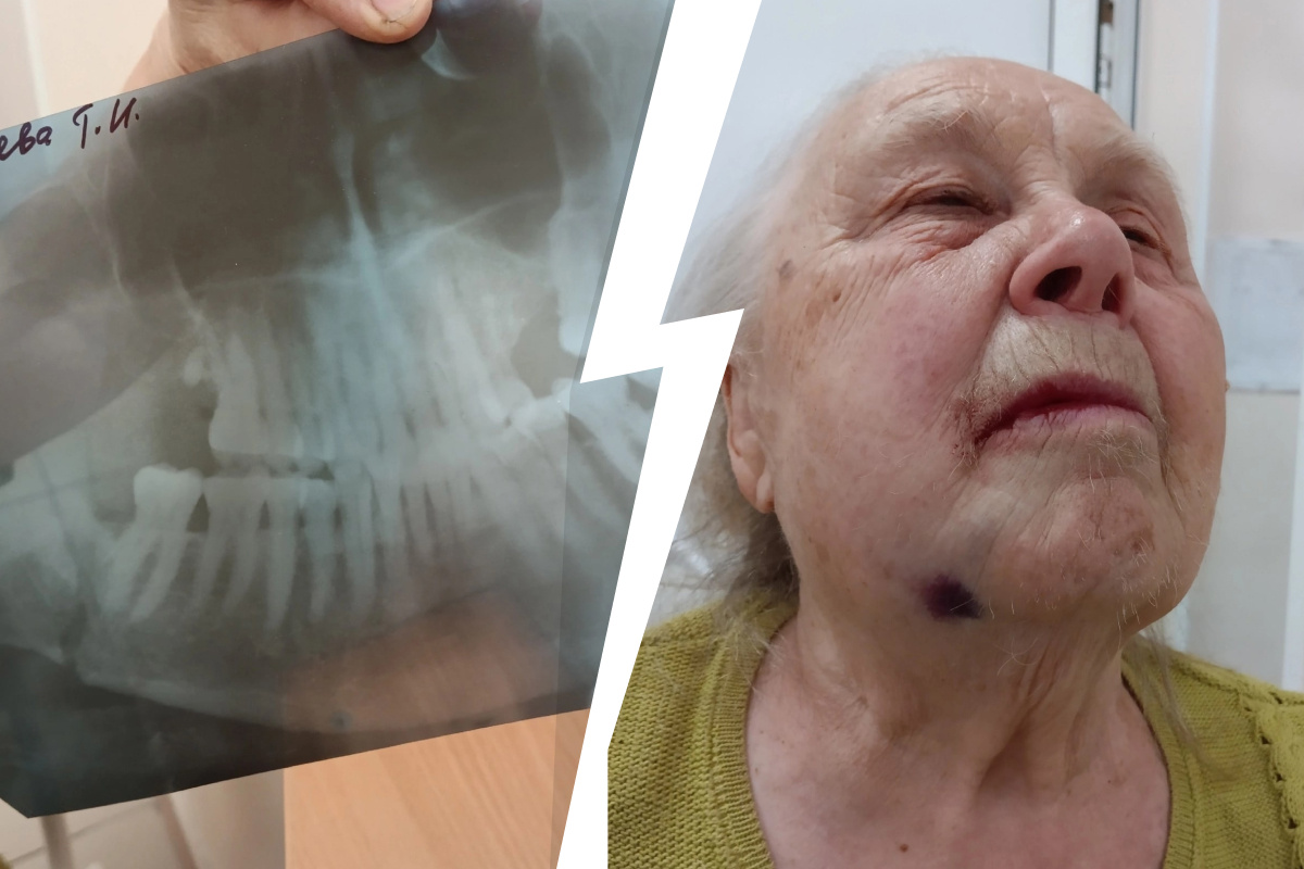 «Два часа издевались над ней». На Урале медики сломали челюсть 85-летней бабушке, пытаясь вырвать зуб мудрости