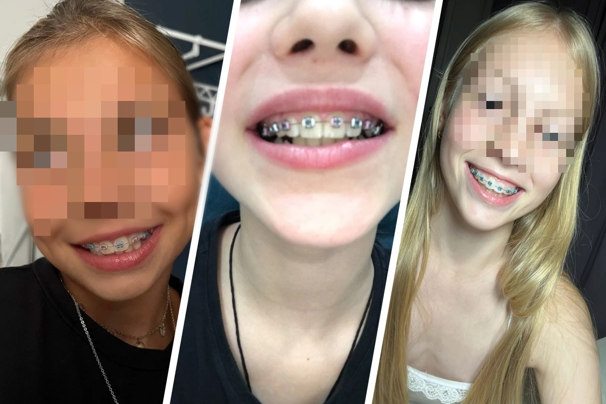 В Нижегородской области дети массово скупают фейковые брекеты и клеят их на зубы, чтобы быть модными — безопасно ли это