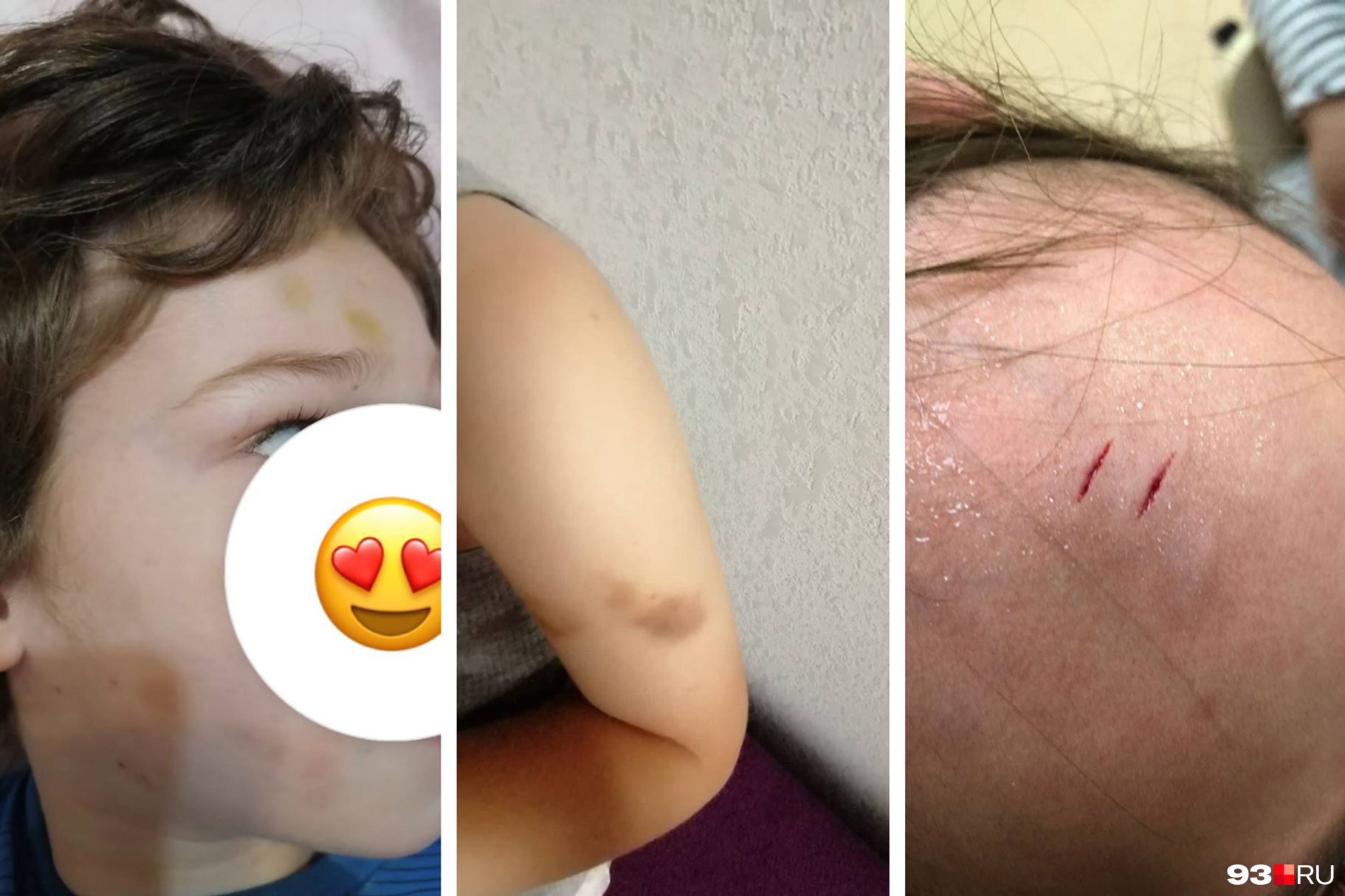 На первых двух фото — синяки Дамира, на третьем — рассеченный лоб Дарины На первых двух фото — синяки Дамира, на третьем — рассеченный лоб Дарины