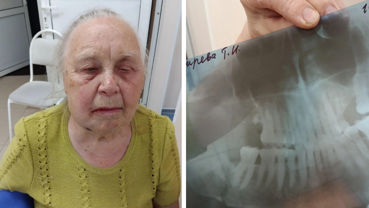 Бабушка отсудила 150 тысяч рублей у стоматологов. Ей сломали челюсть, пытаясь вырвать зуб
