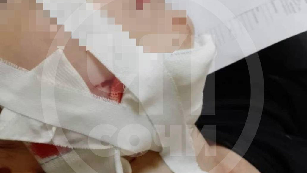 В Сочи домашняя собака напала на ребенка и порвала ему лицо