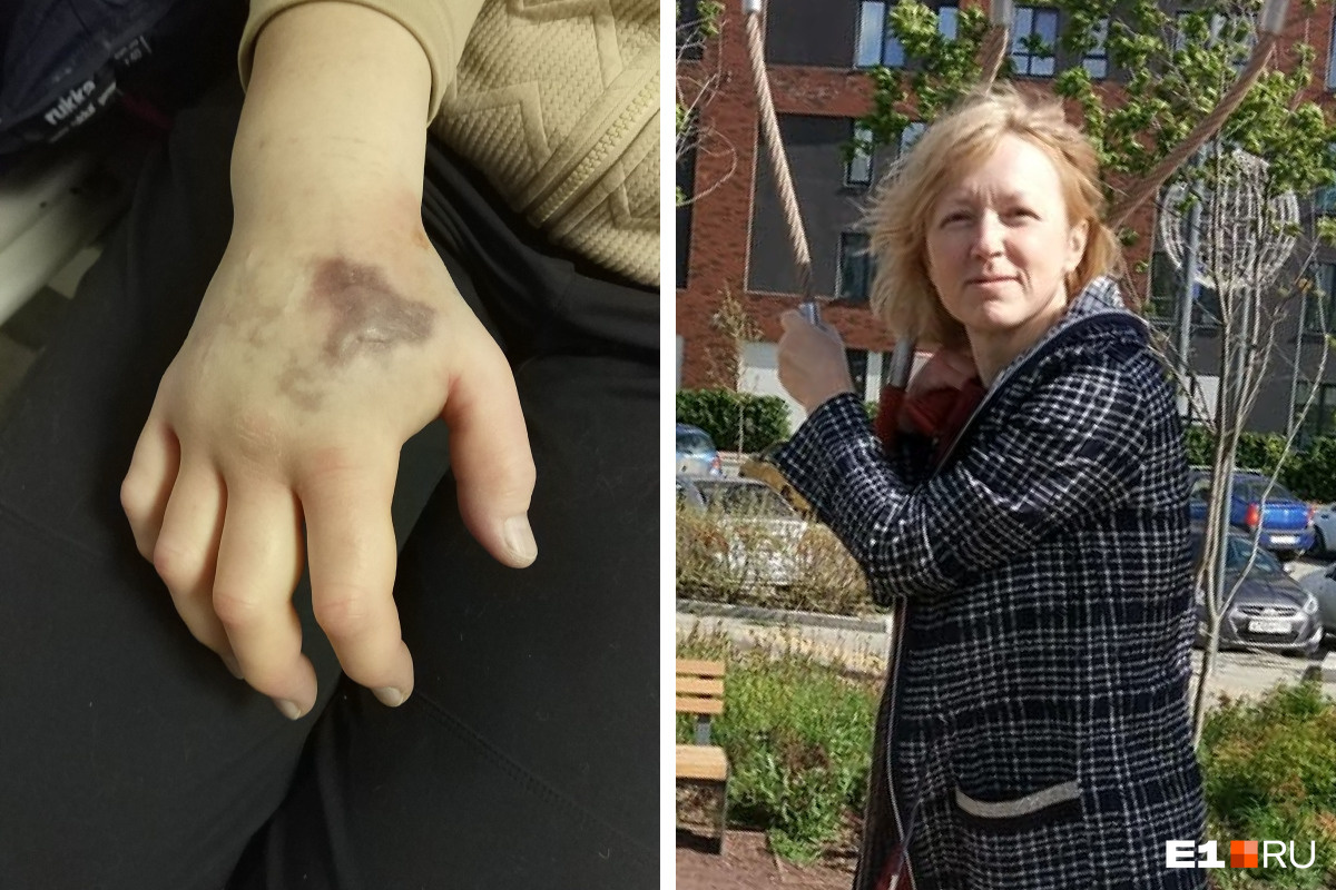 «Боль была нестерпимой». В Екатеринбурге учительнице сделали три операции на руке после неудачной томографии
