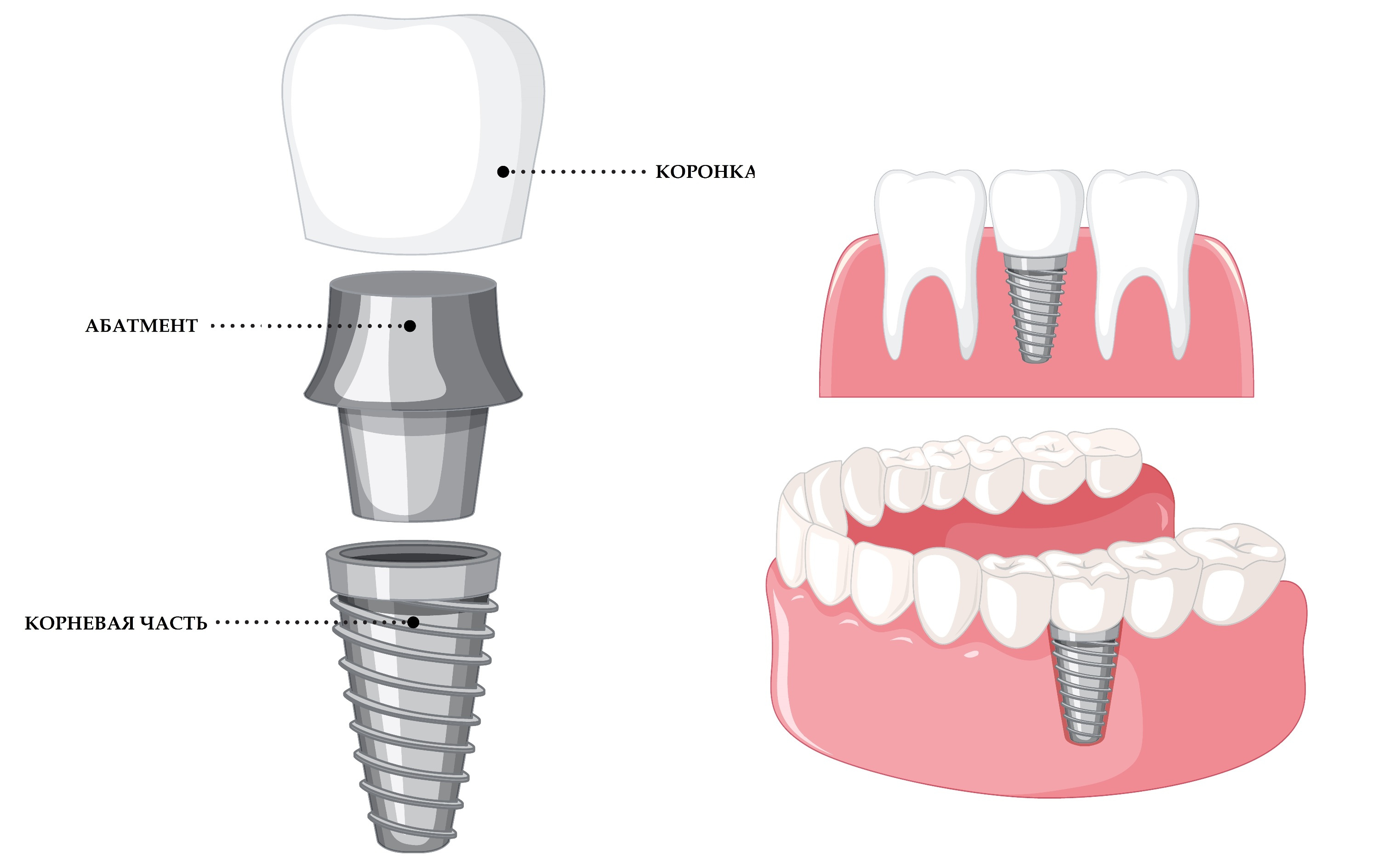 Зубной имплантат состоит из трех основных частей