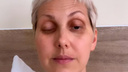 «Через 30 часов в глазах стало раздваиваться»: визажистке из-за ботулизма парализовало лицо