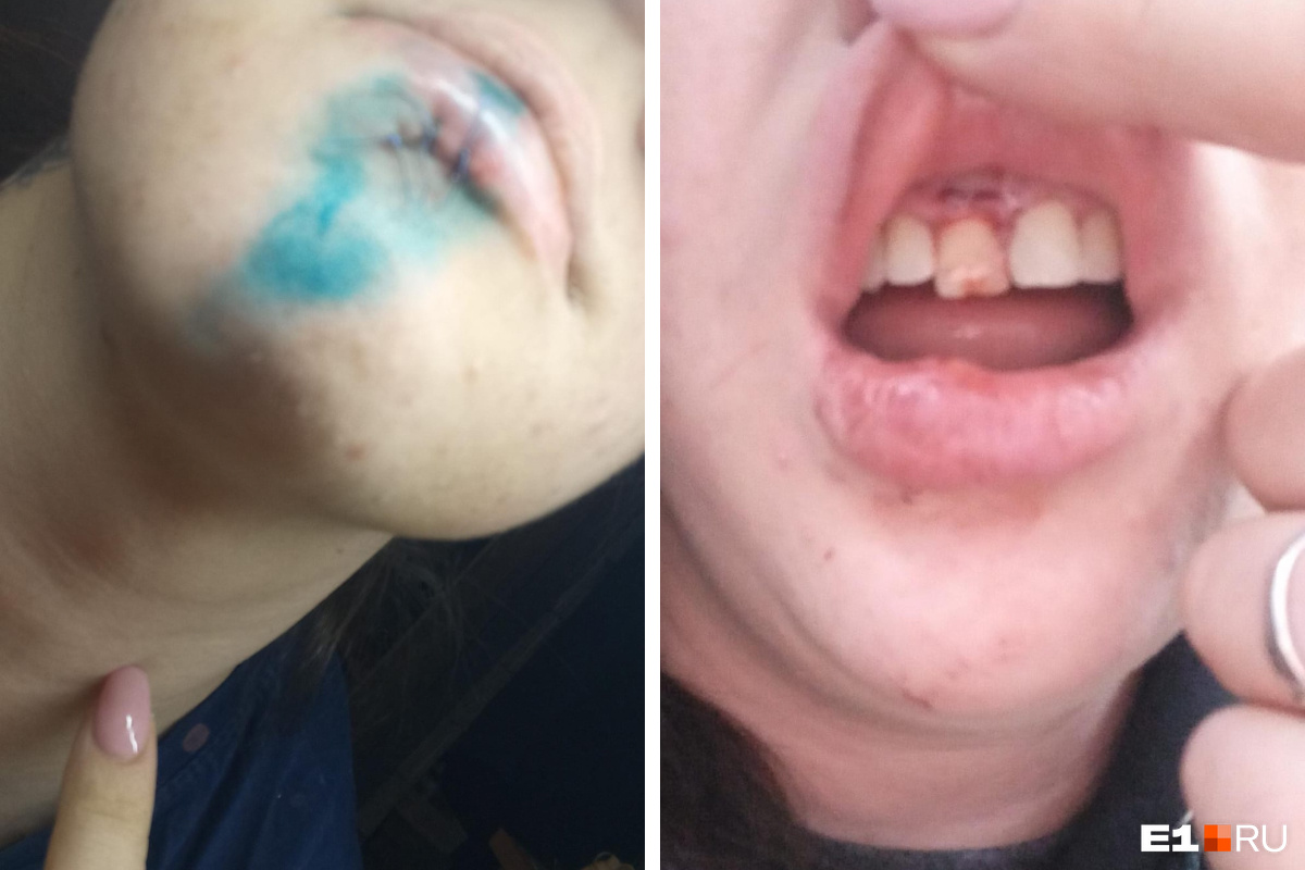 «Кричала на весь салон»: в Екатеринбурге на девушку в автобусе напал мужчина. Он рассек ей губу и сломал зуб