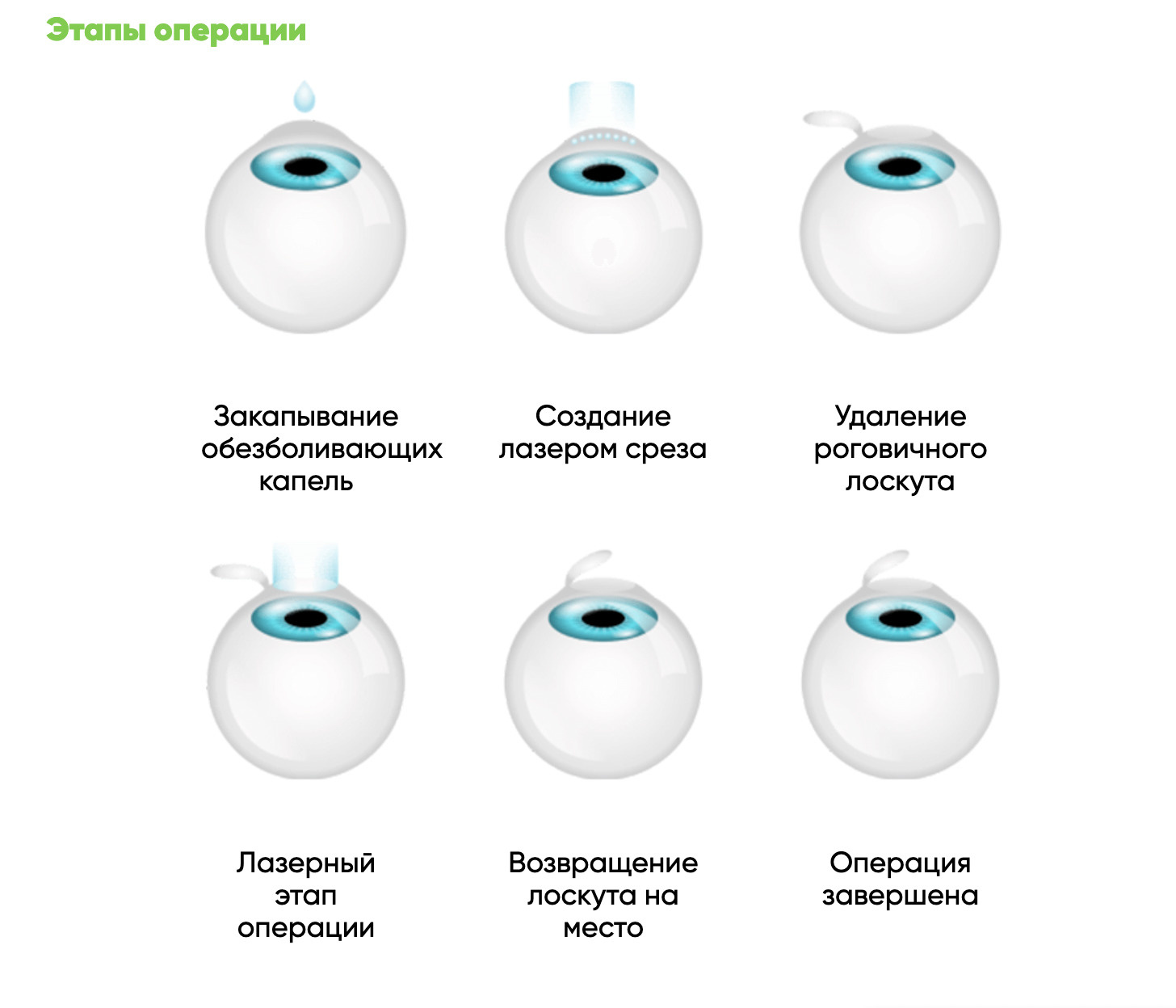 Методы лазерной коррекции зрения