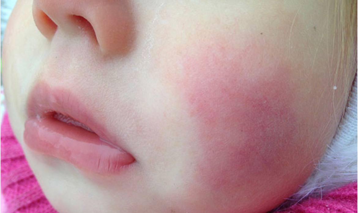 Это не аллергия! Педиатры объяснили, почему щеки ребенка пылают и как избежать обморожения