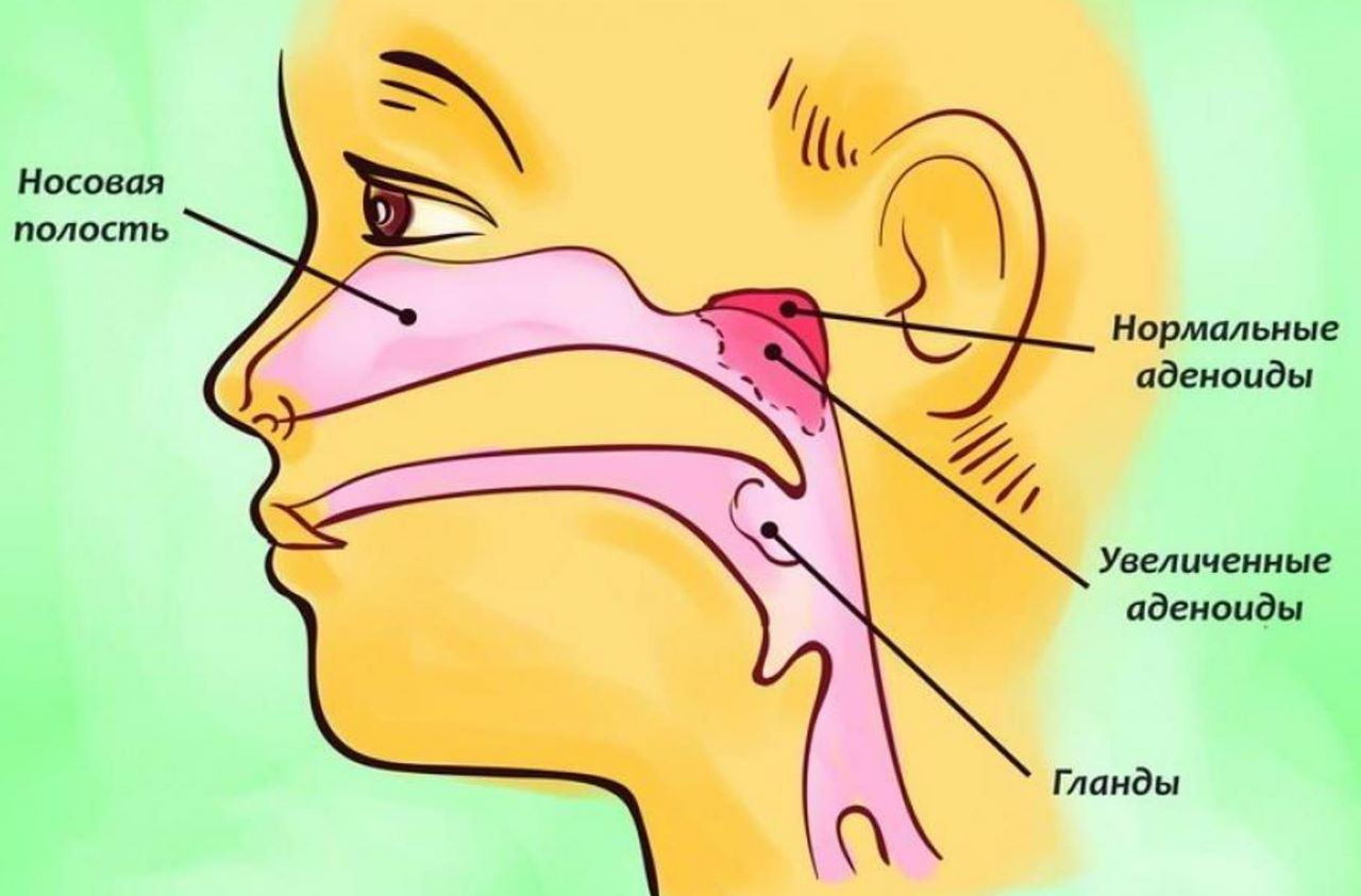 Заложенность носа 9 лет. Аденоиды у детей анатомия. Строение горла аденоиды. Строение носоглотки аденоиды.