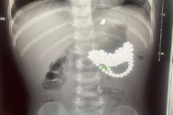 Магниты в теле ребенка, рентгеновский снимок