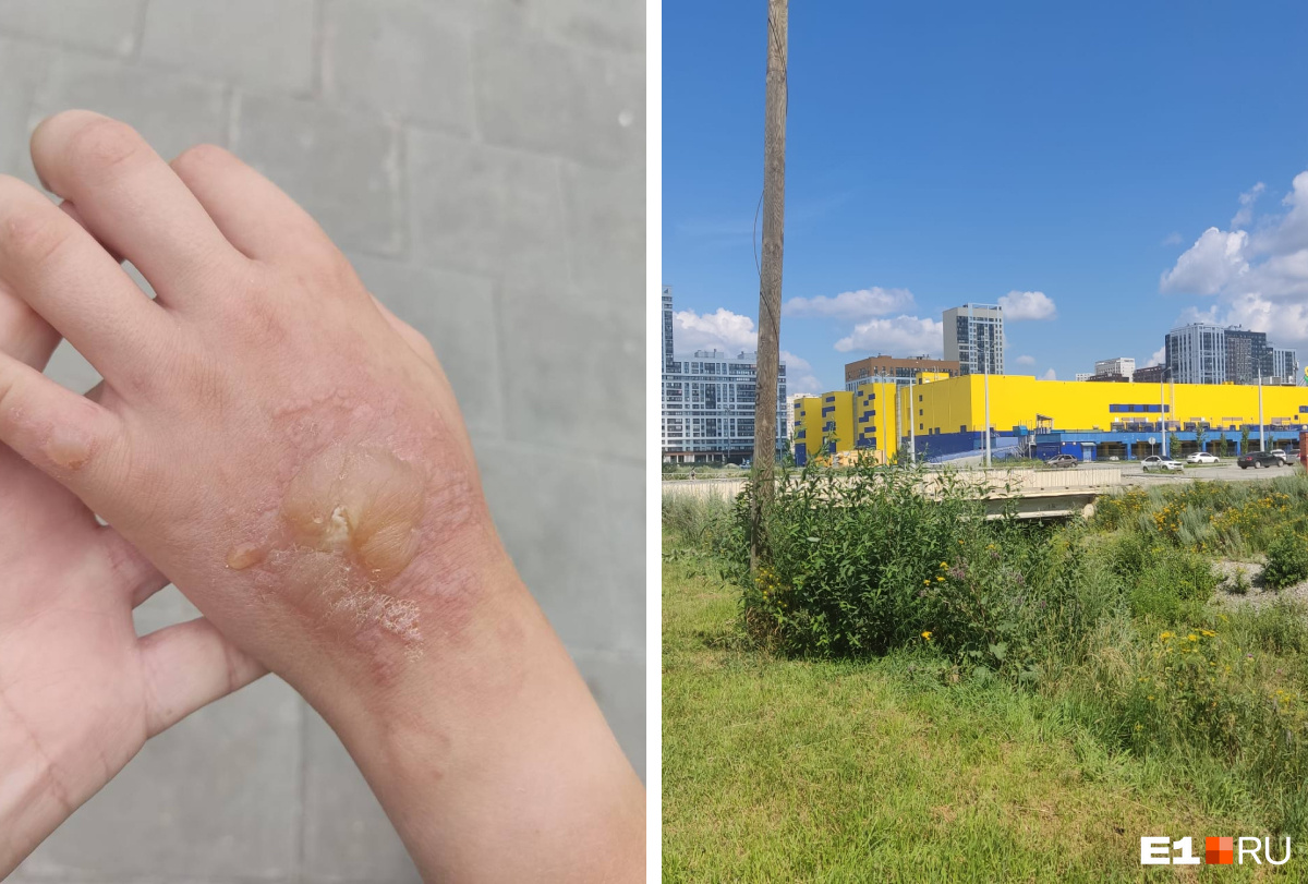 «Действует как борщевик». В Екатеринбурге 10-летний мальчик сорвал цветок и получил серьезный ожог
