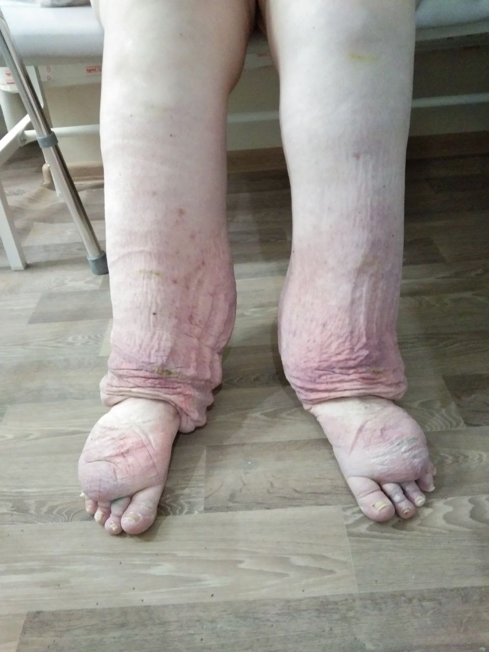 Так ноги Натальи стали выглядеть после курса массажа