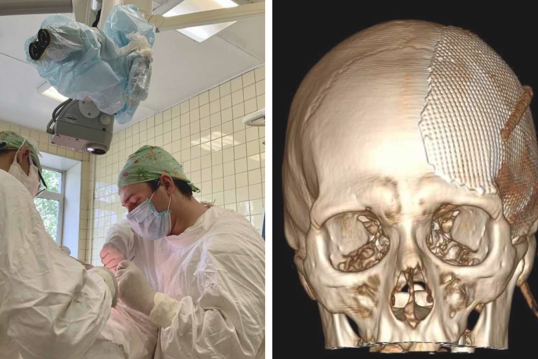 Уральские нейрохирурги спасли мужчину, сделав часть черепа из титановой сетки