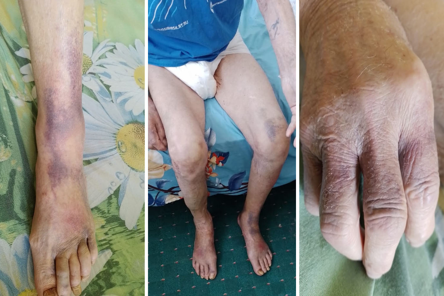 Ноги и руки ветерана покрыты гематомами