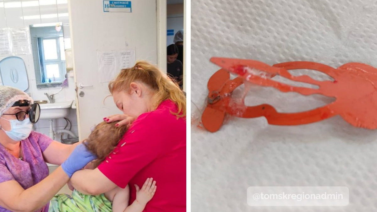 Томские врачи достали железную заколку из горла маленькой девочки