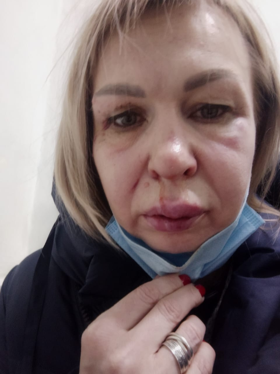 Это фото Наталья Артамонова сделала после драки с соседкой. Медики установили, что многодетная мать сломала Наталье нос