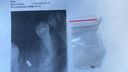 Новосибирский стоматолог оставил в челюсти пациентки кусок бура