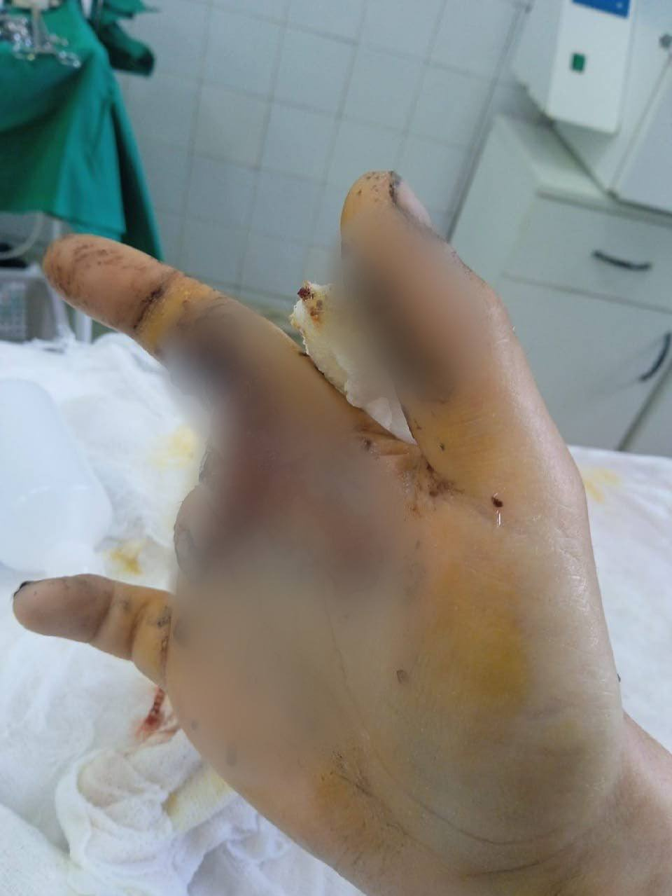 Так рука Артема выглядела после госпитализации