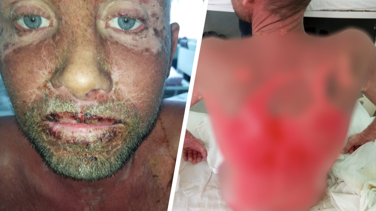 «Чуть ли не голое мясо». Житель Прикамья попал в больницу и получил страшную аллергию на лекарства — у него слезла кожа